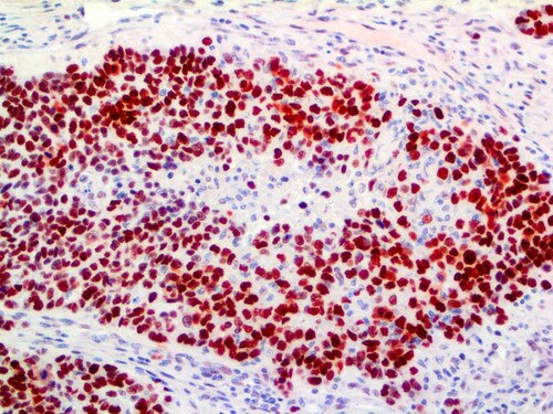 IHC of p53 on an FFPE Breast Carcinoma Tissue